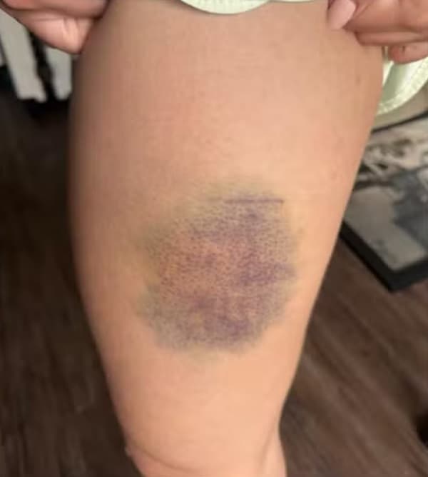 Picture shows the injuries on Jessica Soares' body, undated. She confronted a stranger who attempted to rape her in her apartment in Baueri, Brazil. Note: Private photo. (Newsflash/NX)