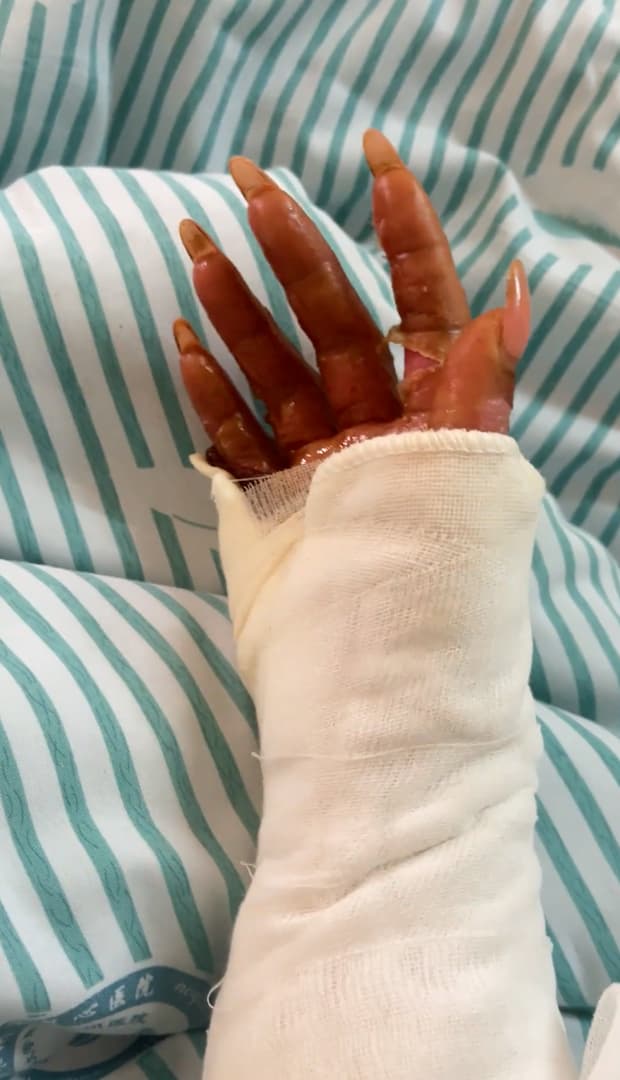 Video shows the injured livestreamer Sisi in undated footage. When she went out to pick up a package from the shoe rack, the package exploded. Sisi was hit by the blast and suffered burns of varying degrees to her face, neck, and both arms on Oct. 15, 2025. Note: Photo is a screenshot from a video. (AsiaWire/NX)
