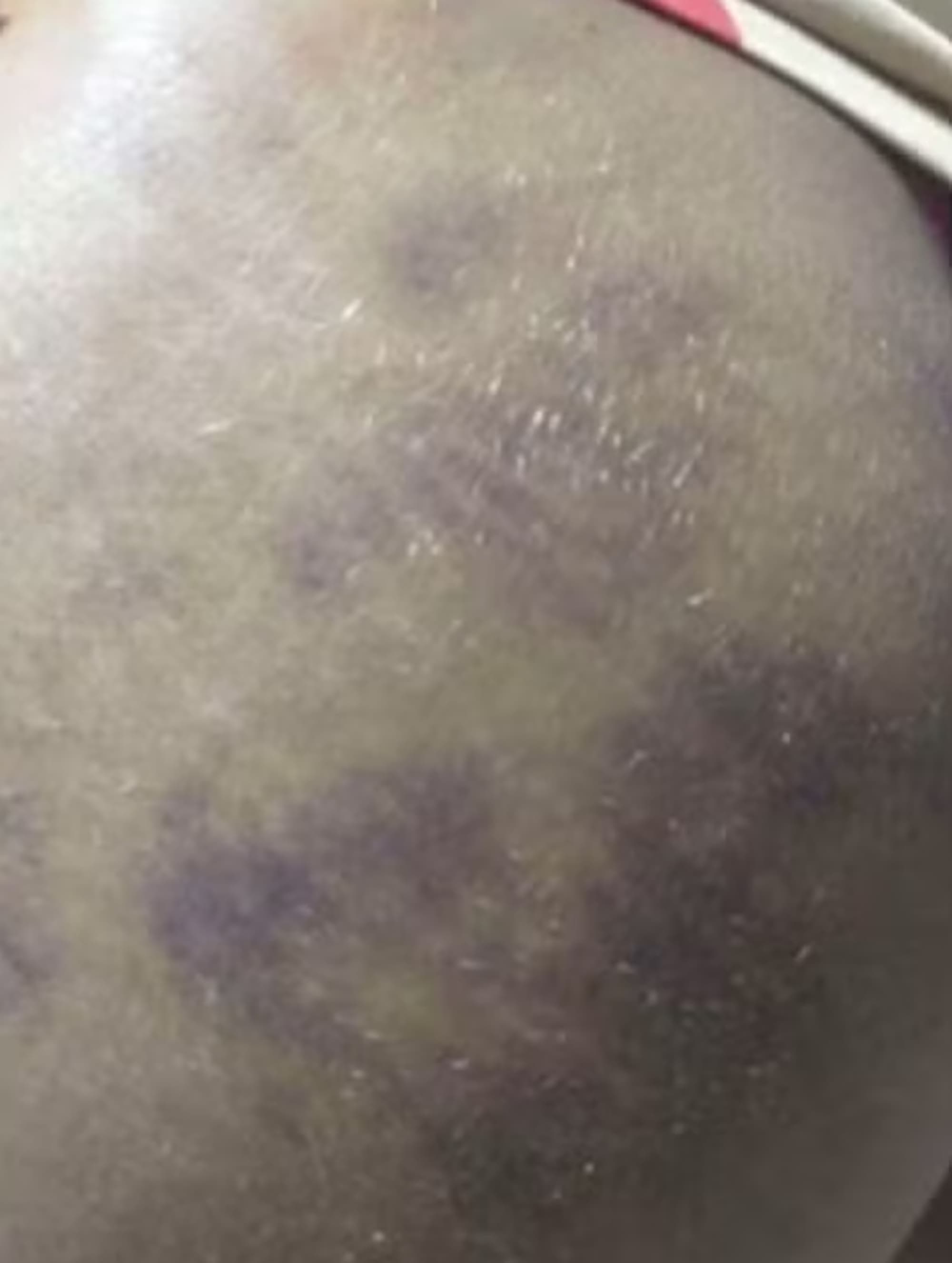 Picture shows bruises after a procedure completed by the suspect. Isabela Dantas was arrested on suspicion of posing as a doctor and injecting construction silicone into buttocks. Note: Private picture. (Newsflash/NX)